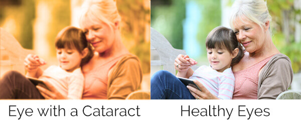 What Its Like to See With a Cataract Compared to Normal Vision