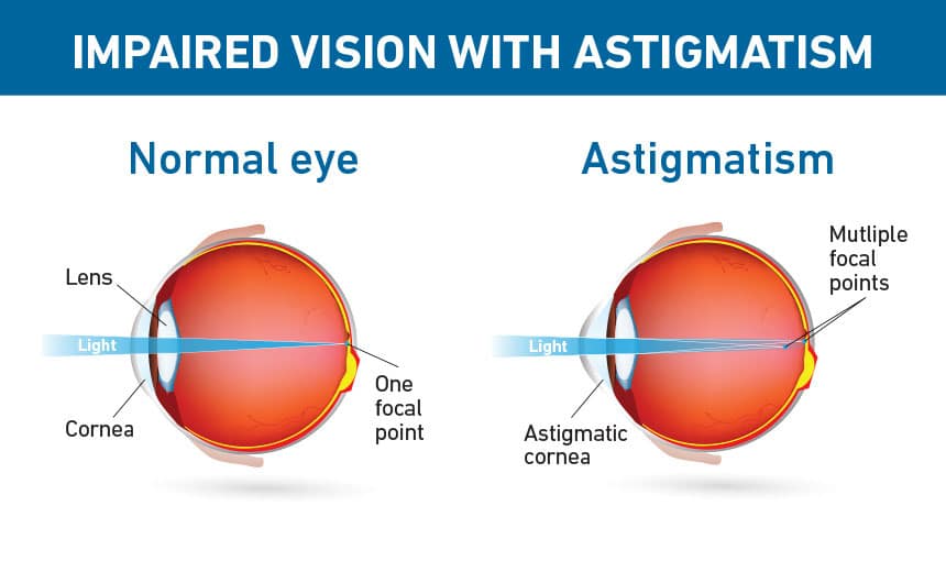 Chart Illustrating a Normal Eye Compared to One With Astigmatism