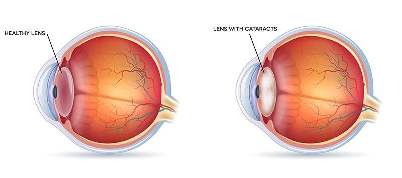 Chart Showing a Healthy Lens vs a Lens With a Cataract